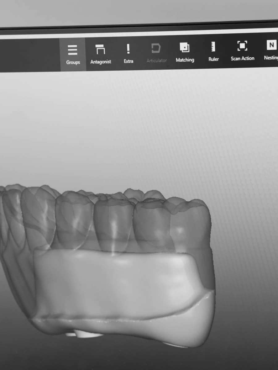 A full-arch prosthesis being designed on screen.